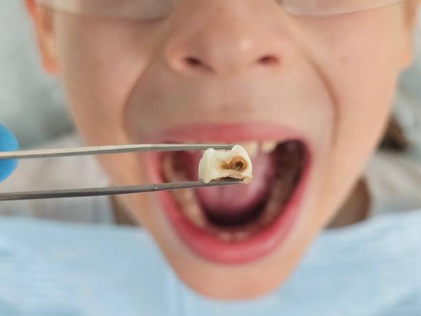 Best Chipped Tooth Repair Near Me  in Avalon, NJ